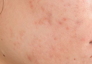 Larocheposay ArticlePage Acne How to get rid of scars and marks